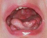Mikroglosja